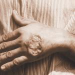 Damien Foundation: The butterfly effect